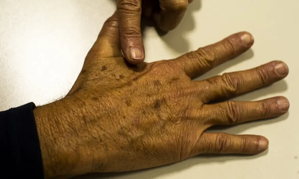 cancêr de pele - melanoma