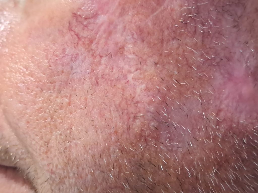 pele cirurgia Cancer de Pele